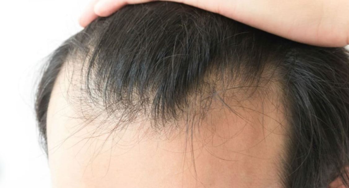 alopecia