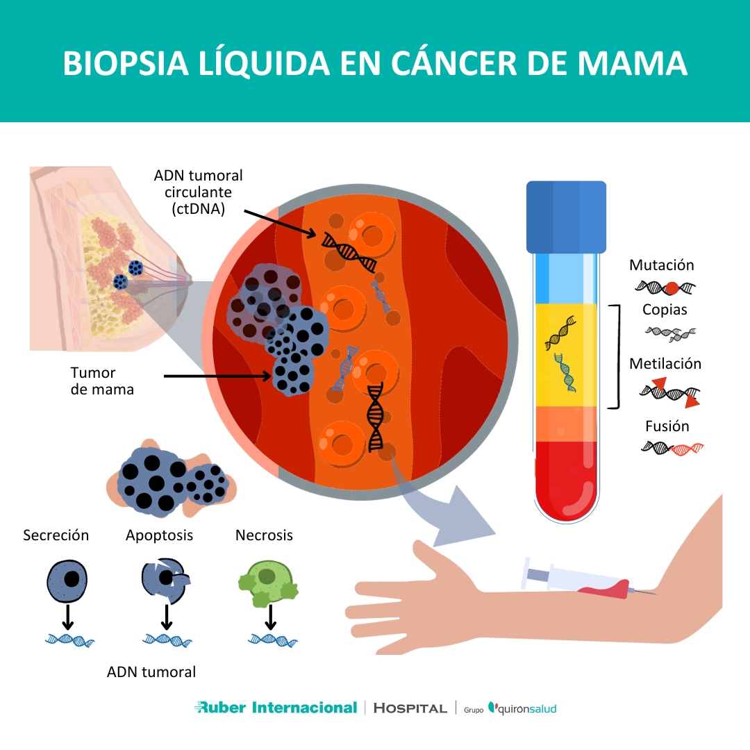 Qué es la biopsia líquida Cáncer de mama