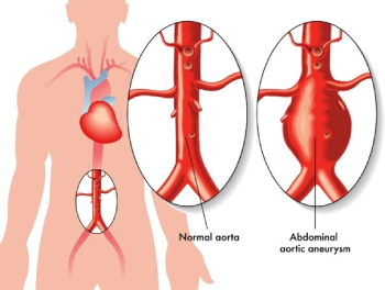 aneurisma de aorta abdominal