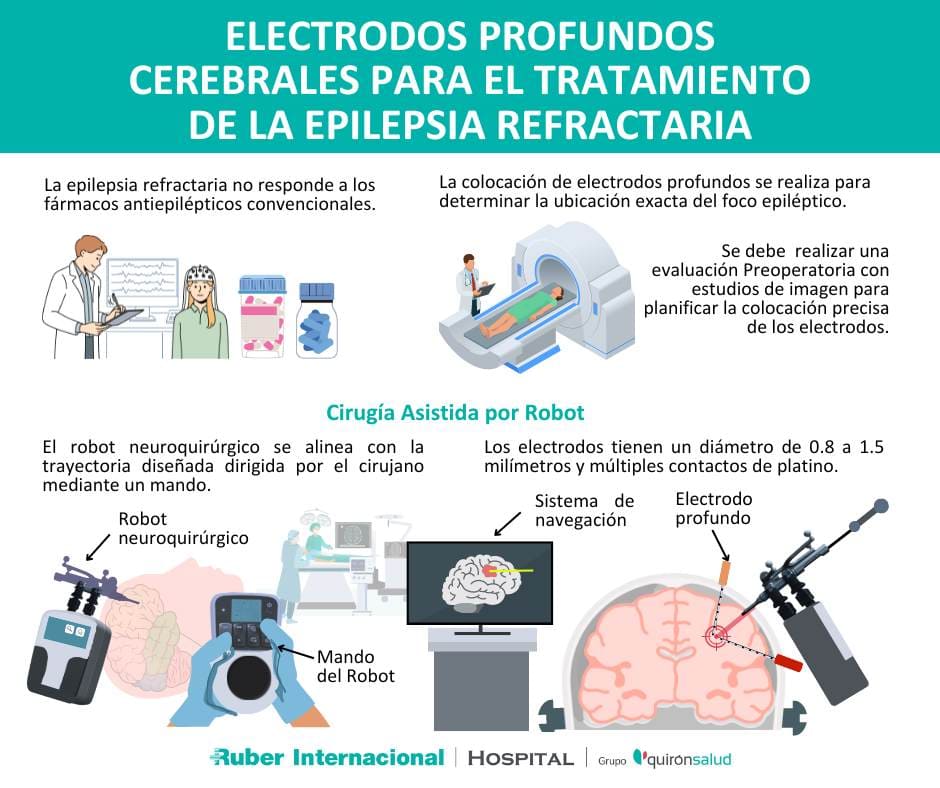 Colocación Electrodos cerebrales profundos robotica epilepsia refractaria