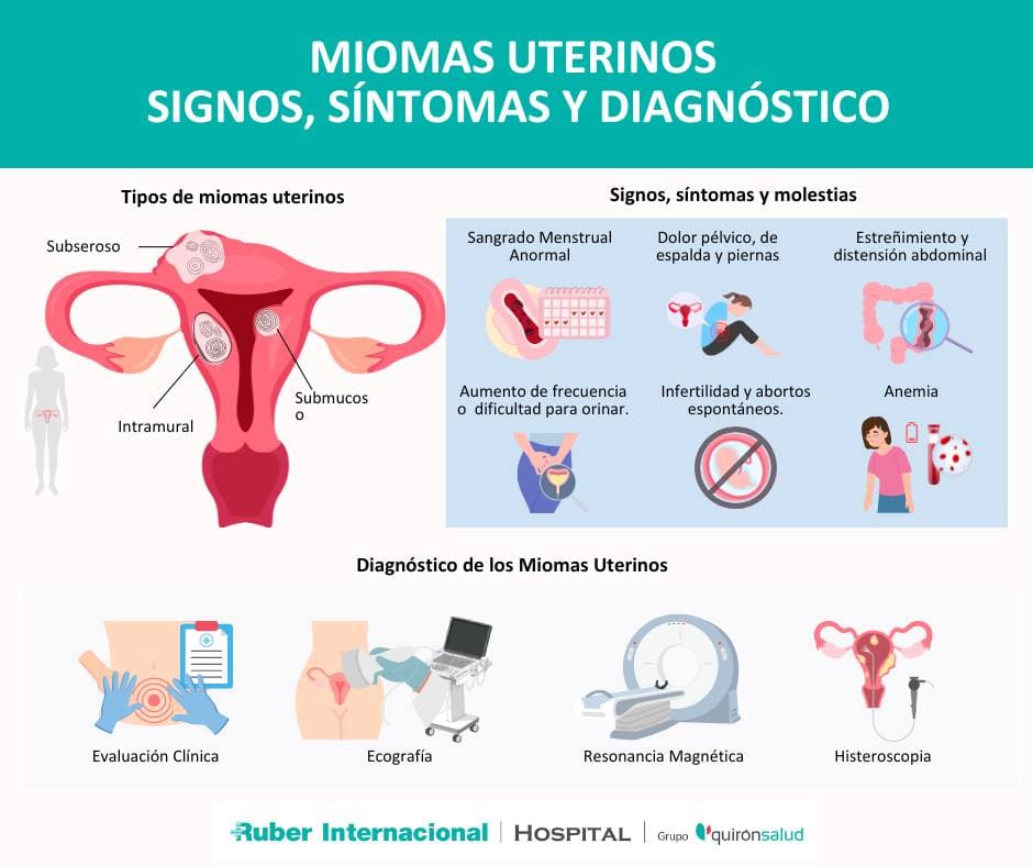 Miomas uterinos diagnóstico síntomas tratamiento