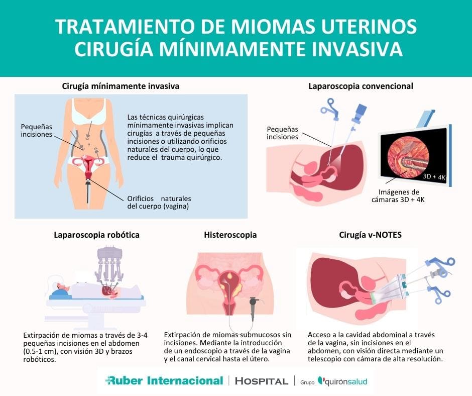 Tratamiento mioma uterino laparoscopia histeroscopia vNotes