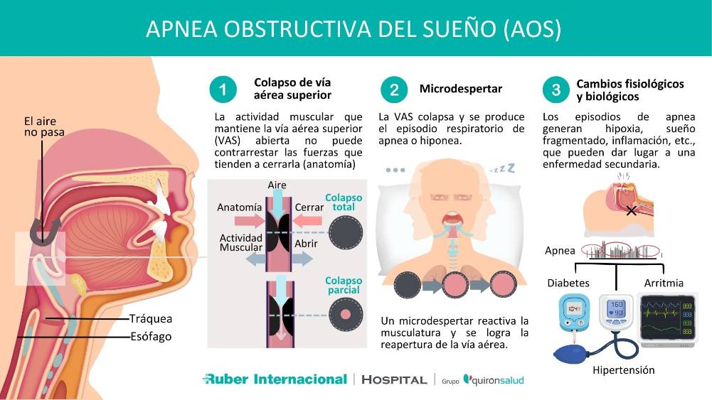 Tratamiento de la Apnea obstructiva del sueño (AOS)