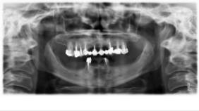 Curso de implantología_Sallanches