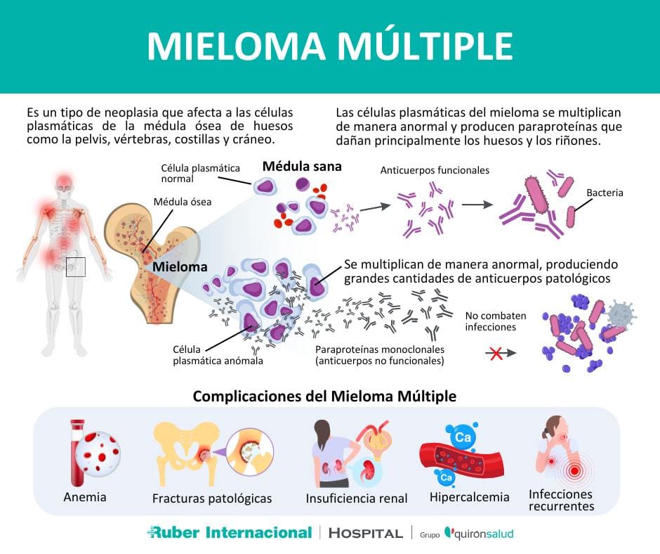 que es Mieloma multiple