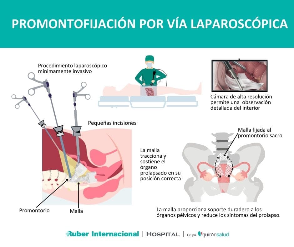 promontofijación tratamiento prolapso organos pelvicos laparostopia