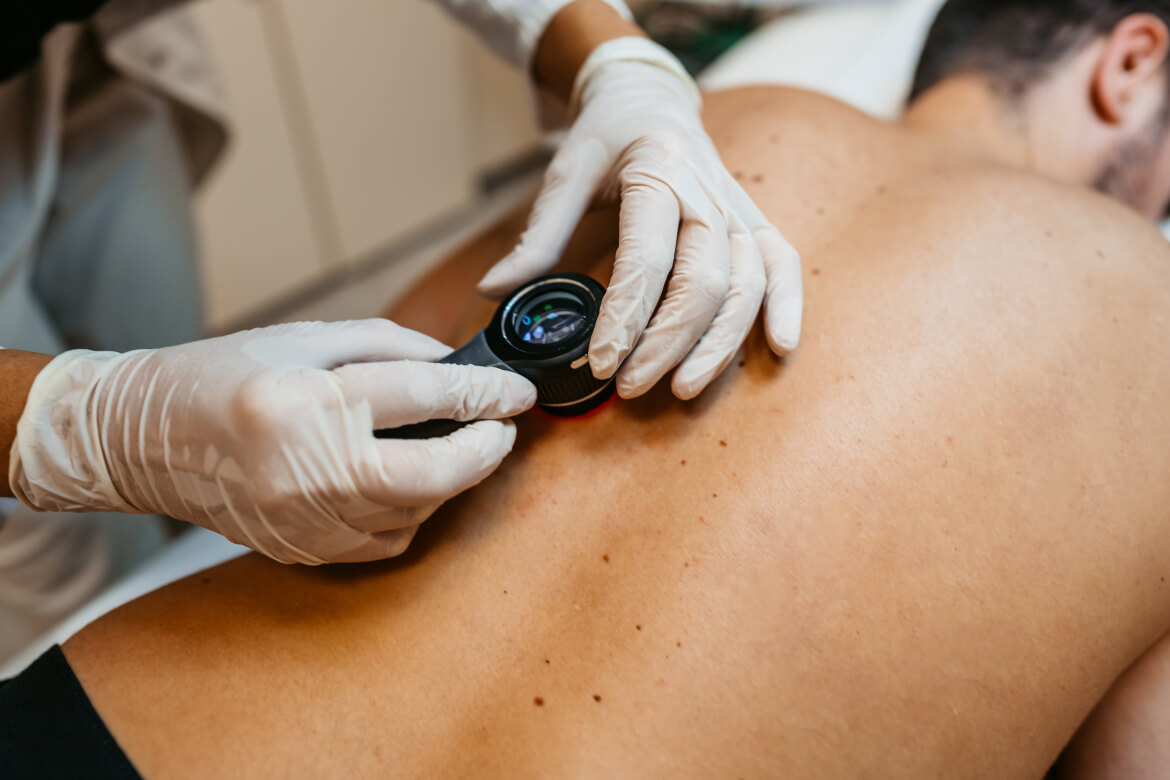 melanoma-dermatologia-husc