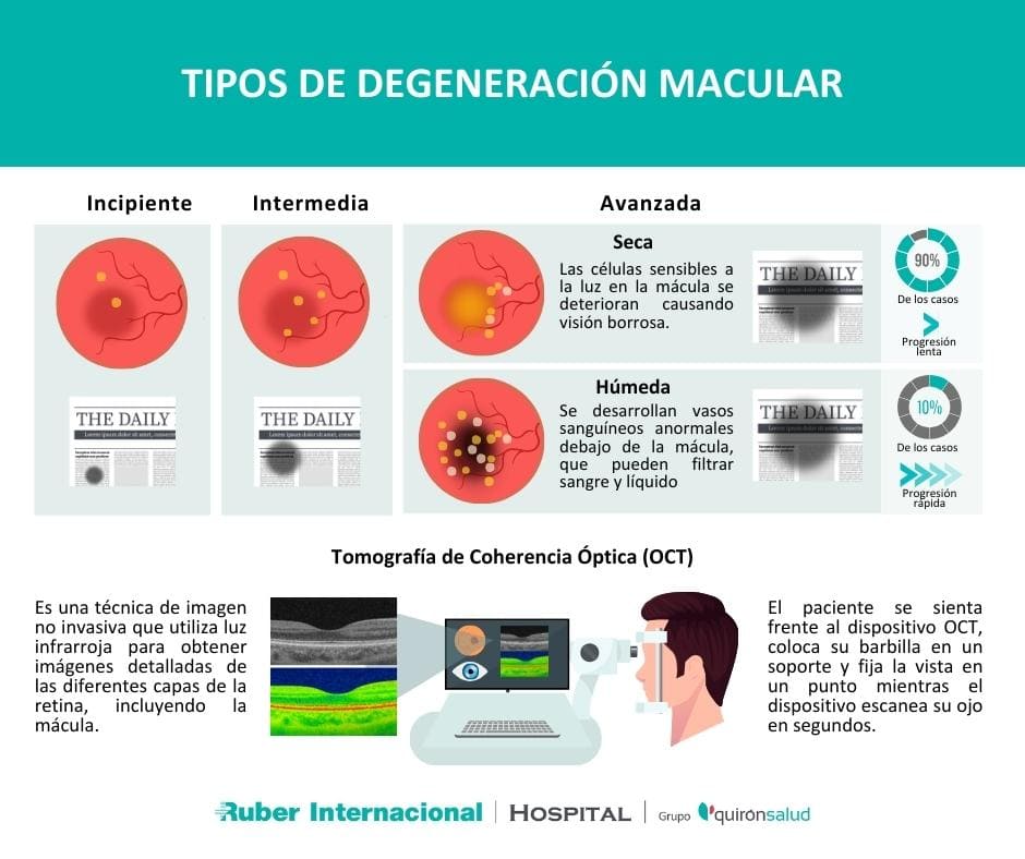 tratamiennto degeneracion macular tipos OCT diagnostico
