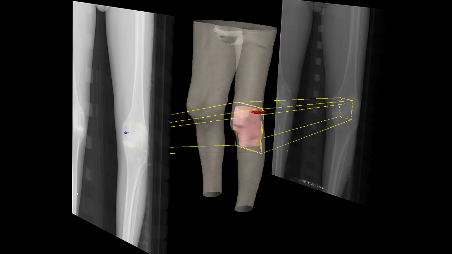 Tratamiento radioterápico de artrosis de rodilla