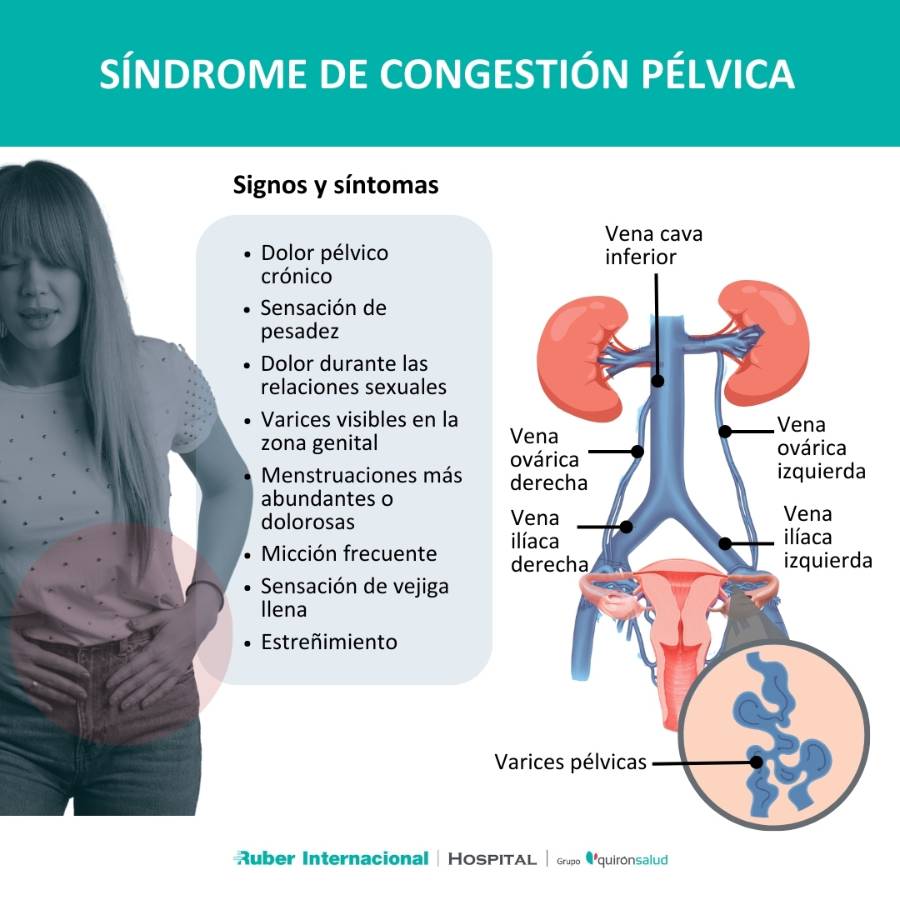 Tratamiento mínimamente invasivo de las varices pélvicas