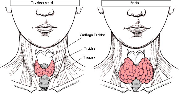 Nódulo tiroideo ¿Qué es, cómo saber si es maligno, cuándo operar? Blog  de tiroides