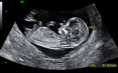 La ecografía doppler - inatal - El embarazo semana a semana