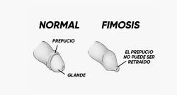 Anillo 2025 fimotico tratamiento